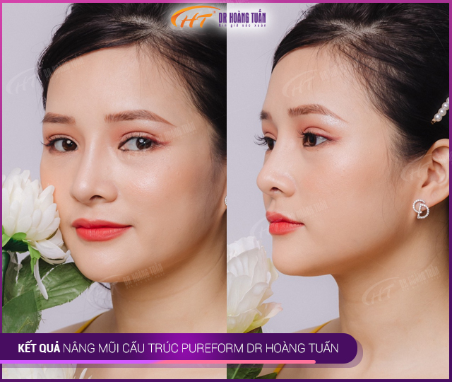 Kết quả nâng mũi Pureform tại Thẩm mỹ Hoàng Tuấn